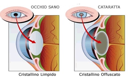 Cataratta, nuovi rimedi Cataratta