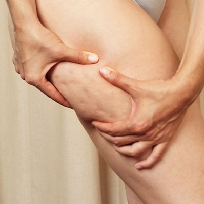 Salute, l’80% delle donne è afflitta dalla cellulite Cellulite