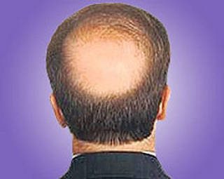 Dagli USA la pillola anti calvizie ma gli esperti consigliano prudenza calvizie