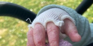 La storia di Olivia e dei bambini farfalla epidermolisibollosa