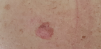 Tumori cutanei, prima si riconosce la patologia, prima si arriva alla diagnosi ed alla cura tumoricutanei