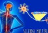 Sclerosi Multipla, una malattia tempo-dipendente sclerosimultipla