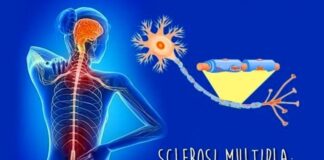 Sclerosi Multipla, una malattia tempo-dipendente sclerosimultipla